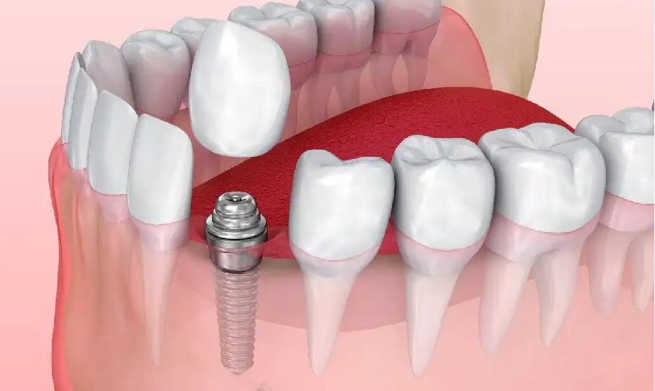 植得口腔医生：多颗牙缺失该如何补救？这份种植牙攻略请收藏！
