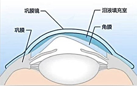 爱尔英智眼科巩膜镜验配，为男子解决角膜移植术后多重问题