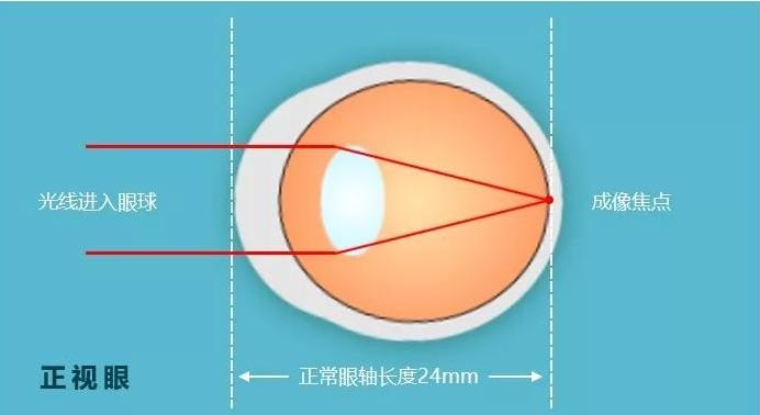 普瑞眼科—眼球的发育和近视的生成